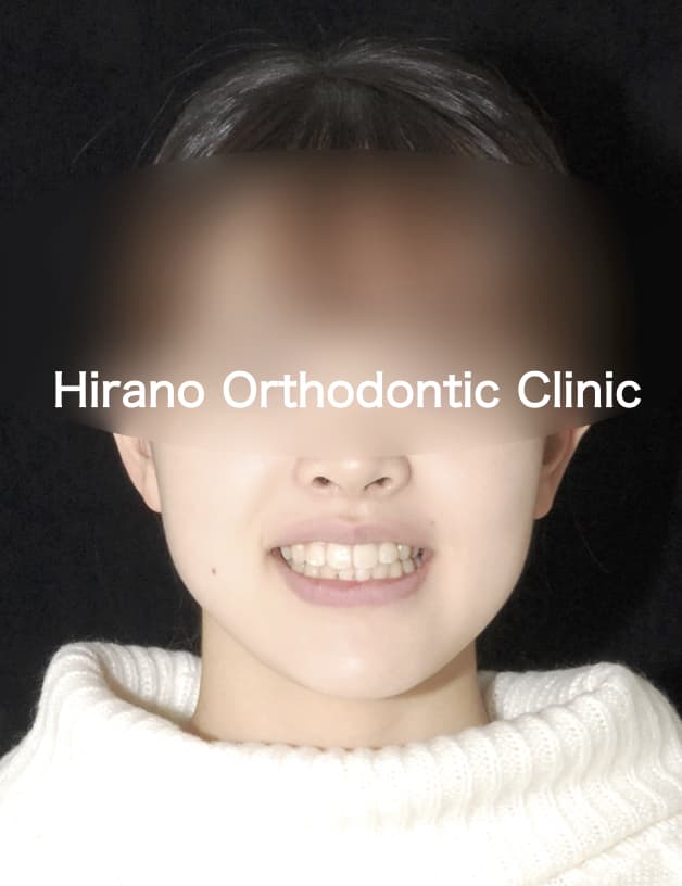 笑顔の患者さんが歯科治療を受けている様子