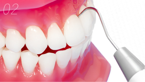 歯肉など歯周組織の健康